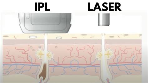 The Difference Between Ipl And Laser Hair Removal How To Choose