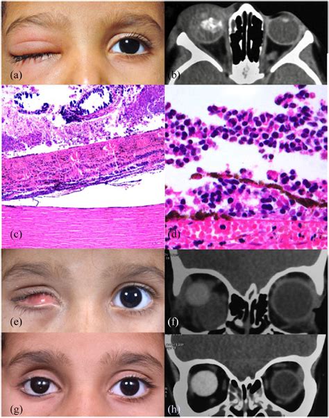 Retinoblastoma Histology