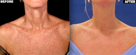 Age Spots Union Square Laser Dermatology