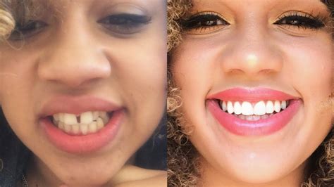 Gapped Teeth Before And After Braces Mainsnap