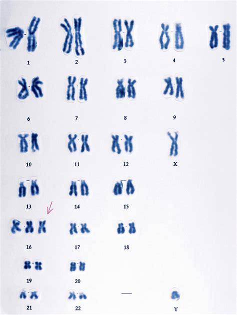 Trisomy 16 Chromosomes Photograph By Cnriscience Photo Library Pixels