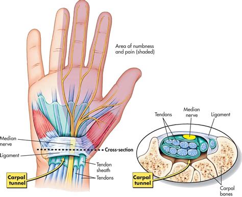 Carpal Tunnel Syndrome Explained