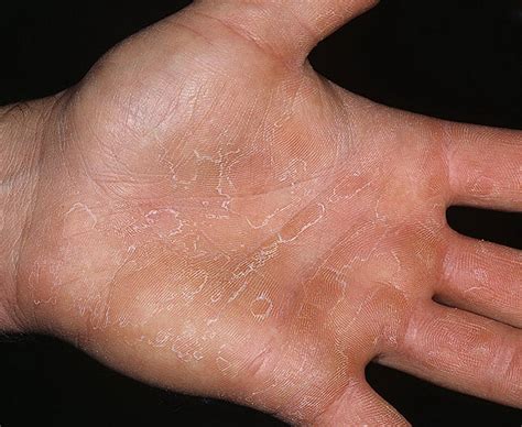 Dry Eczema On Hands Pictures 475 Photos And Images