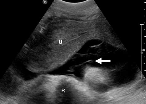Peritoneal And Retroperitoneal Anatomy And Its Relevance For Cross