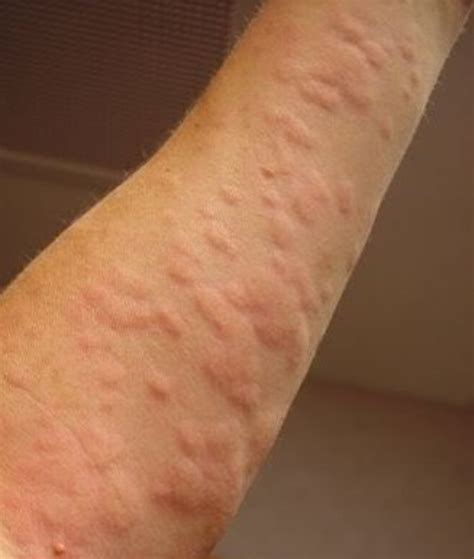 How Can You Get Hives — Natural Remedies Hubpages