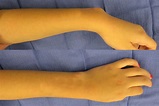 MADELUNG'S DEFORMITY | Hand Surgery Source