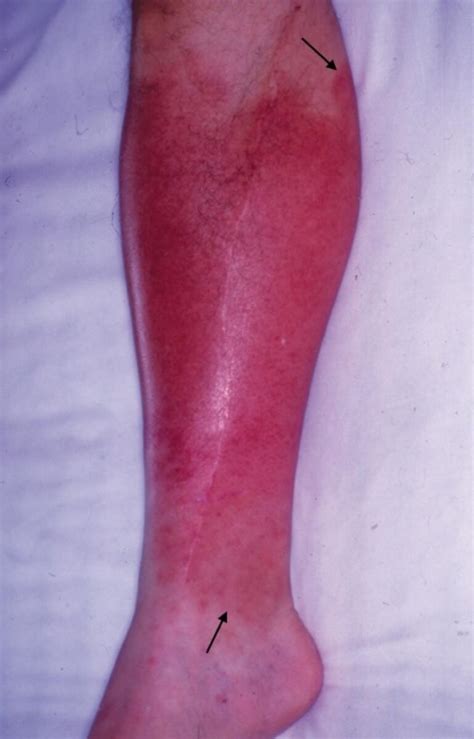 Gravitational Eczema Varicose Eczema