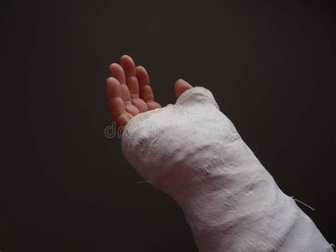 Injured Hand With Cast Stock Photo Image Of Patient 25161484