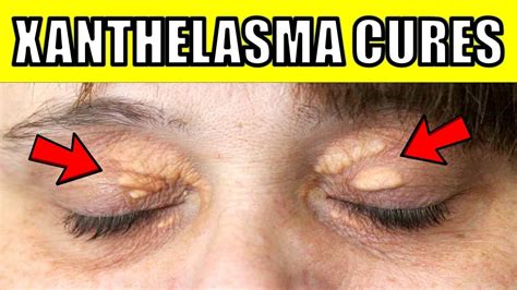 How To Get Rid Of Cholesterol Deposits Under The Eyes Naturally