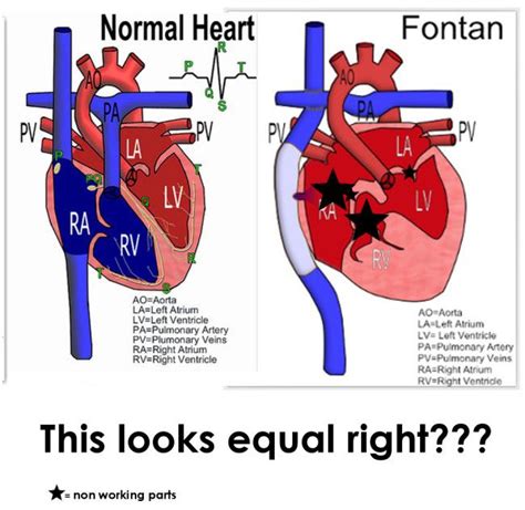 Healthy Heart Vs Fontan Tricuspid Atresia And Pulmonary Atresia