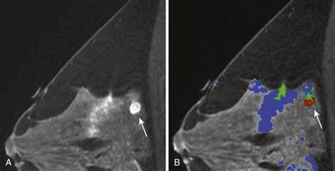 Benign Findings In Breast Mri Radiology Key