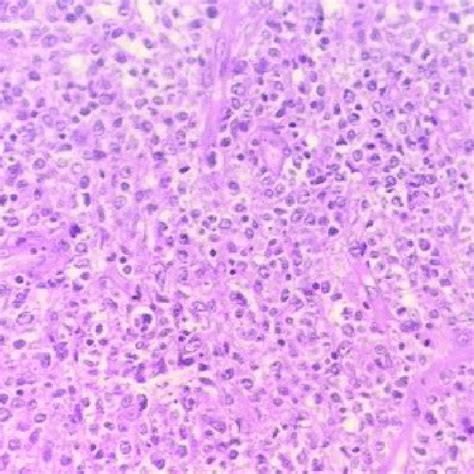 Primary Diffuse Large B Cell Lymphoma Of Cns Proliferation Of Tumor