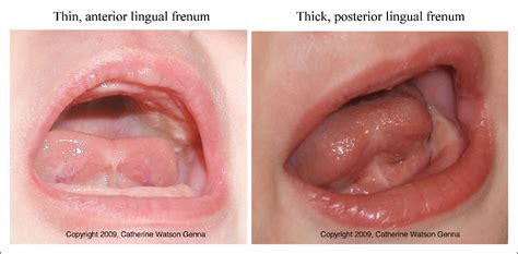 Tongue Tie And Frenotomy In The Breastfeeding Newborn Semantic Scholar