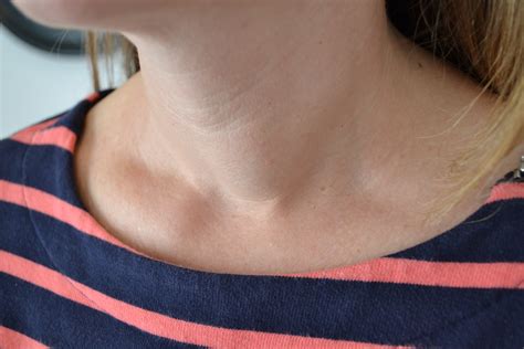 thyroid goiter and nodules 101 what you need to know part two thyroid center of santa monica