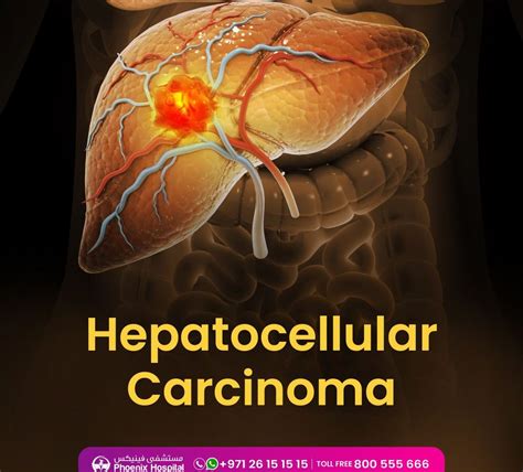 Hcc Hepatocellular Carcinoma Symptoms Treatments Phoenix Hospital