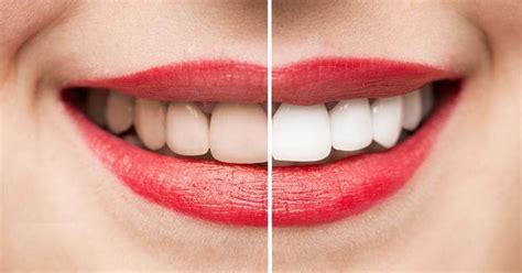 Teeth Whitening Christchurch New Zealand