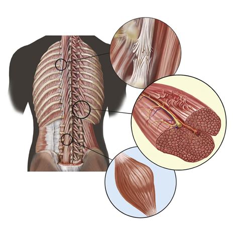 Detail Of Deep Back Muscles With A Close Up Of Sprain Strain And Spasm