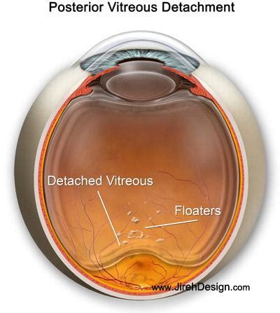 Posterior Vitreous Detachment And Exercise Online Degrees