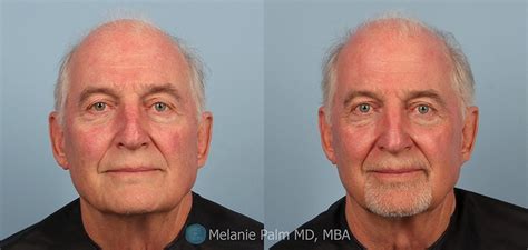 Pdt For Precancerous Lesions Before And After San Diego