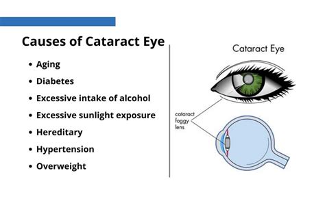 Everything You Need To Know About Cataract Ophthalmology