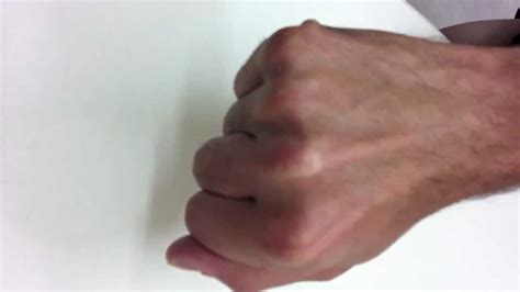 Rheumatoid Finger Tendon Rupture Youtube