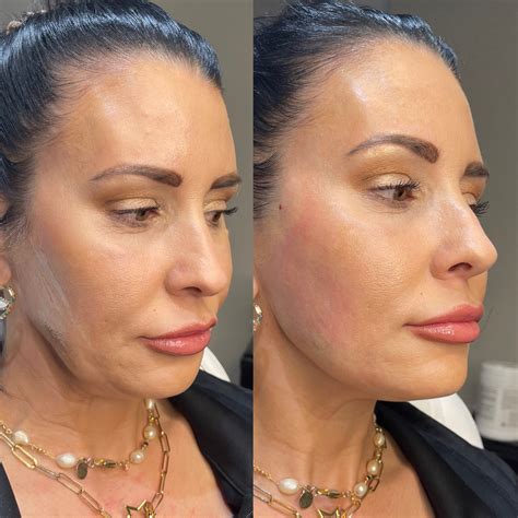 Pdo Jawline Jowl Thread Lift In Clearwater Florida