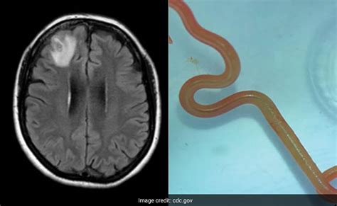 Live Parasitic Worm Found In Australian Womans Brain In World First