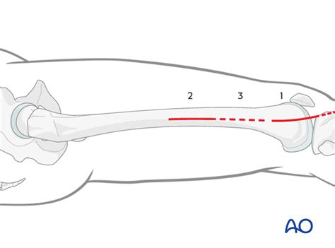 Mipo Approach To The Distal Femur From Lateralanterolateral
