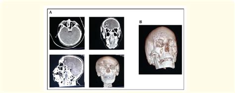 CT Scan Of The Skull On Admission A And After Craniotomy B A