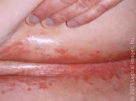 These infections are quite common and often cause an irritating rash. fungal infection under breast pictures - Google Search ...