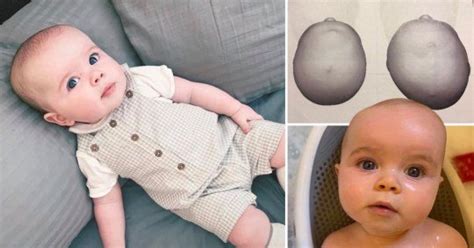 Baby Born With Flat Head Needs £4500 Helmet To Save Him From Skull
