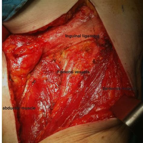 Pdf Changing Perceptions Of Lymphadenectomy And Sentinel Lymph Node