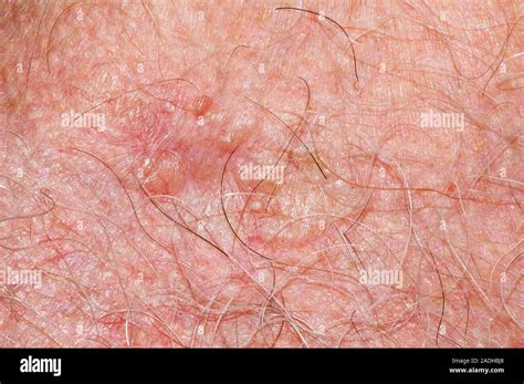 Skin Cancer Basal Cell Carcinoma Bcc Or Rodent Ulcer On The Skin