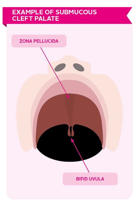 Submucous Cleft Palate