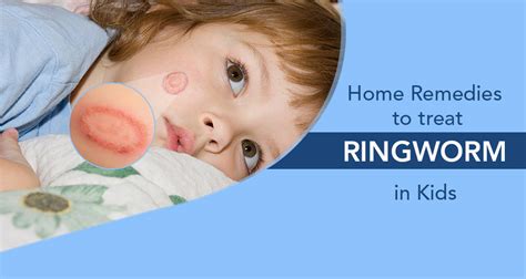 7 Ringworm Home Treatment