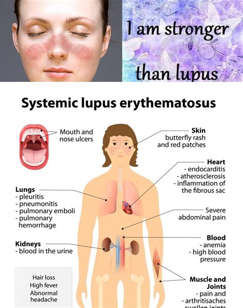 Lupus Systemic Lupus Erythematosus Sle Subodaya Rheumatology Hospital