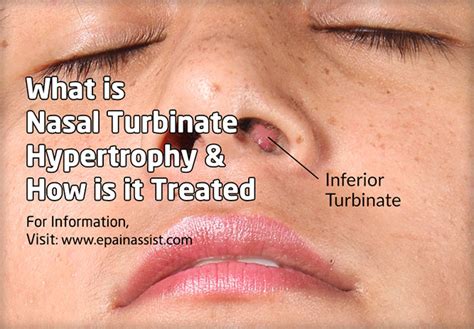 Turbinectomy Procedure