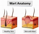 What You Need to Know about Warts - Charleston Dermatology
