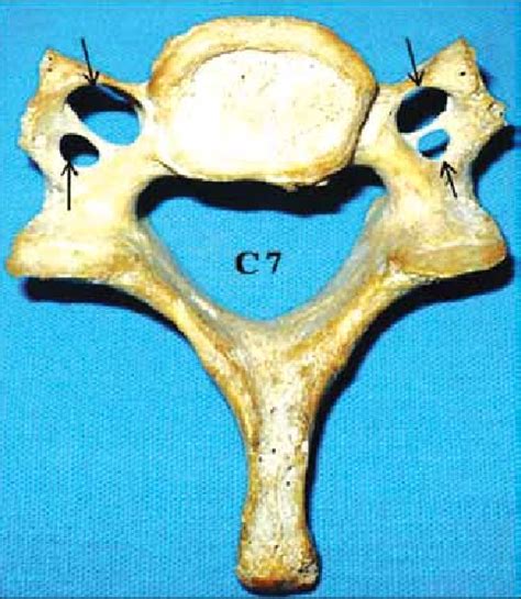 Photograph Of C7 Cervical Spine Inferior View Showing The Bilateral