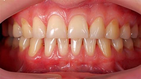 Receding Gums Prevention Treatment And Common Causes Toothstars