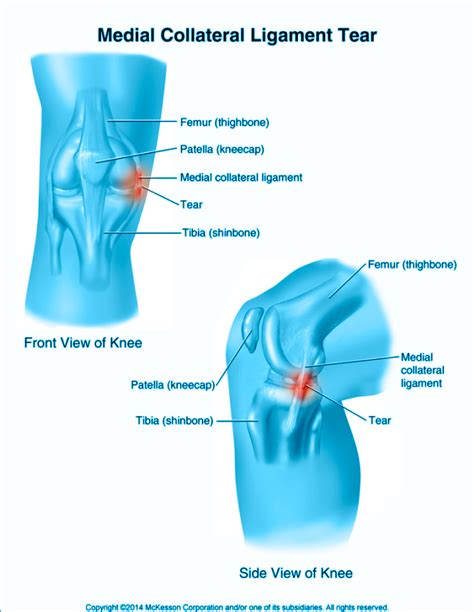 Dr Carlos Godoy Lesi N De Ligamentos Colaterales De La Rodilla