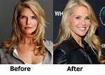 Christie Brinkley Plastic Surgery Before and After | Christie brinkley ...