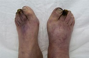 Bilateral Foot Gangrene | Cardiology | JAMA Oncology | JAMA Network