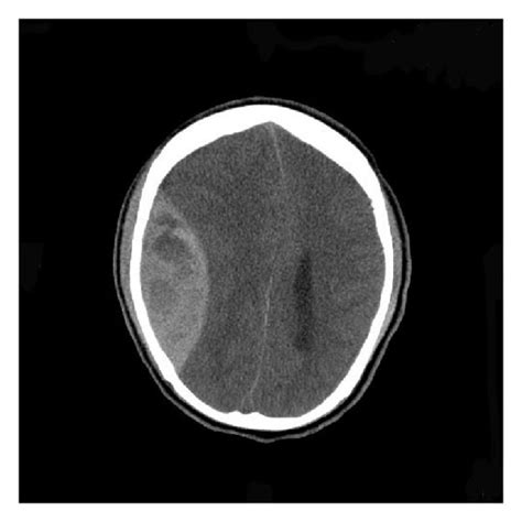 Postop Ct Showing Resolution Of Epidural Hematoma And Postop Changes On