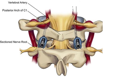 Cureus C Fracture Dislocation And Bilateral Vertebral Artery Porn