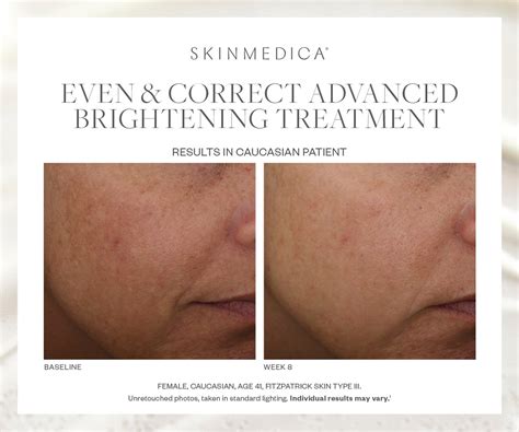 Skinmedica Even And Correct Advanced Brightening Treatment Cosmetic