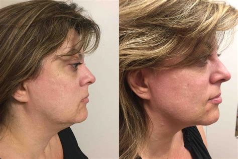 Photodynamic Therapy Pdt Before And After Photos Patient 10 Washington Dc Mi Skin