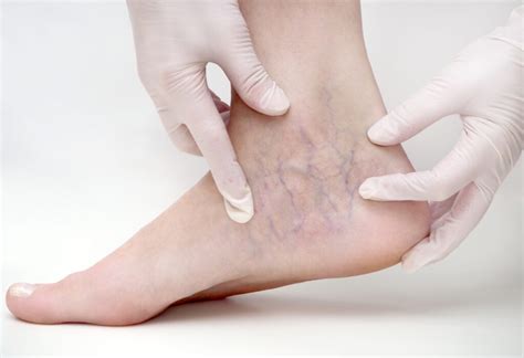 Which Types Of Doctors Treat Varicose Veins Hinsdale Vein And Laser