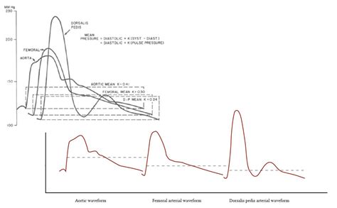 Systolic Diastolic And Mean Arterial Blood Pressure Deranged Physiology