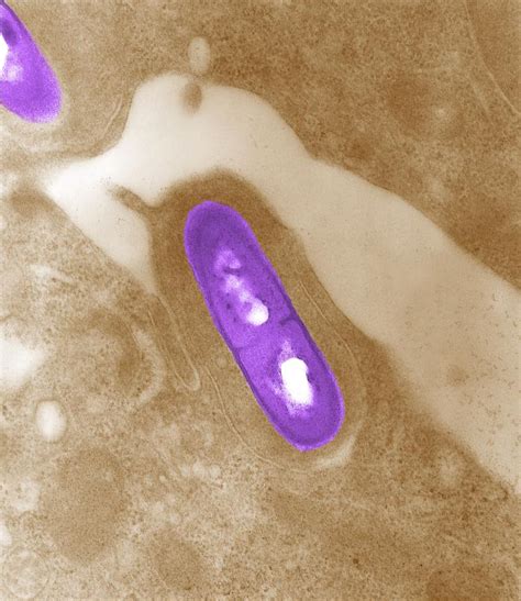 Listeriosis symptoms and signs include diarrhea, nausea, and fever. Listeria monocytogenes - wikidoc